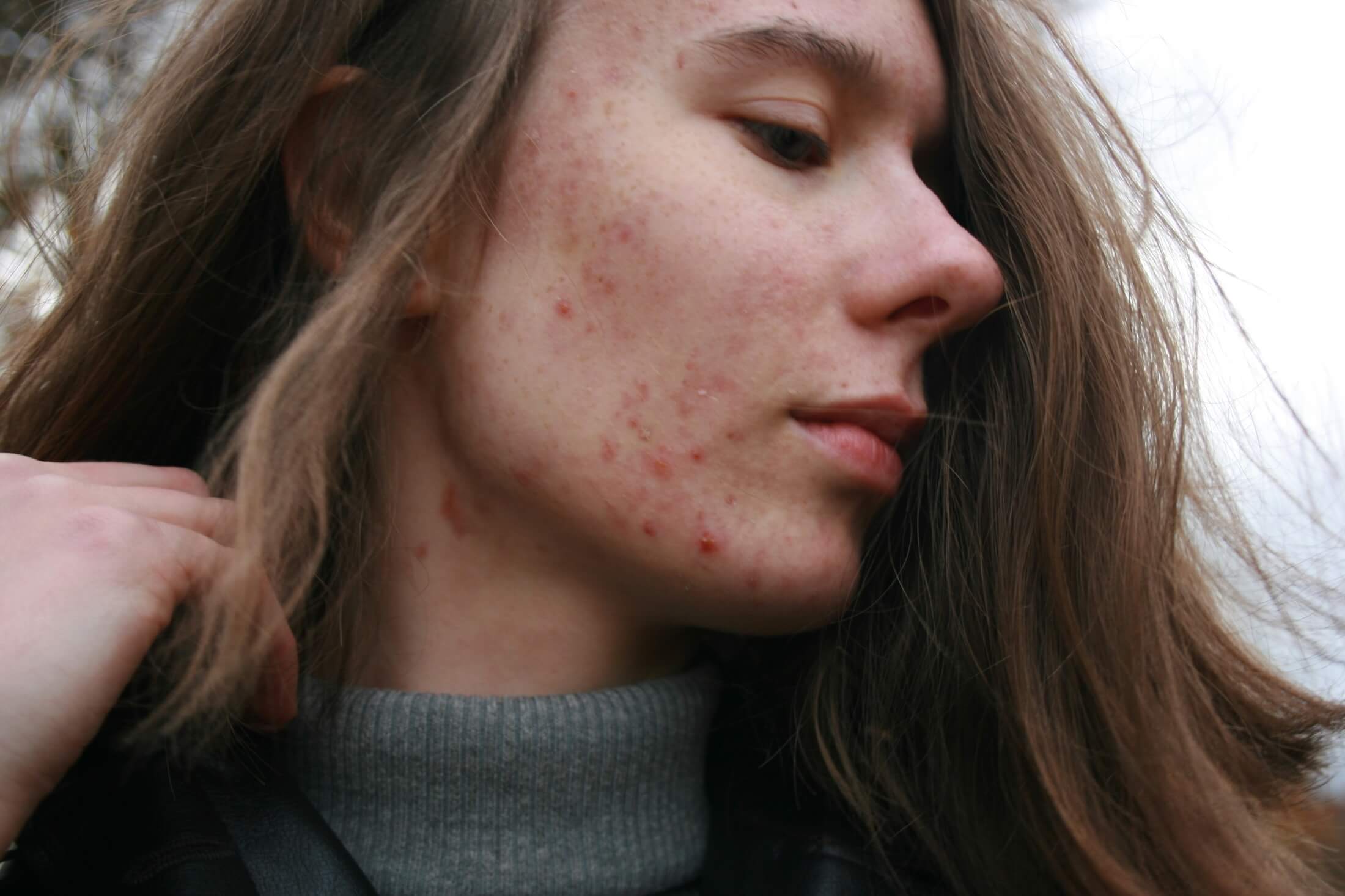 Frau mit Pickel im Gesicht